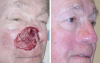 skin-cancer-spots-on-nose-facial-reconstruction-before-and-after-pictures-vysef9kk.png