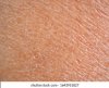 dry-skin-ichthyosis-texture-detail-260nw-1643951827.jpg