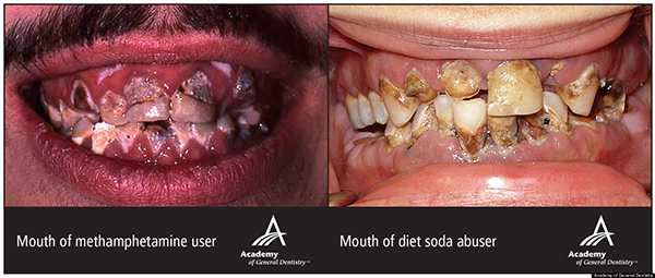 diet-soda-teeth.jpg