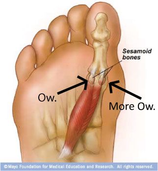 Fractures, Feet and Crocks, Oh my! | Sesamoid bone, Remedial ...