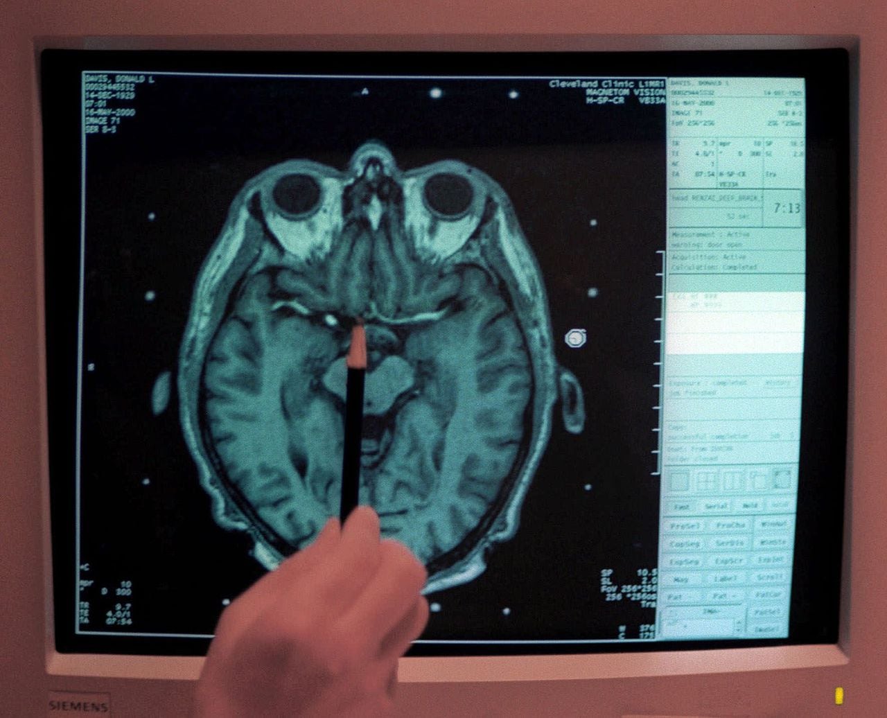 MRI human brain